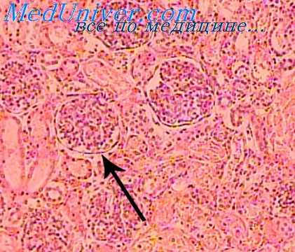 сладжирование крови