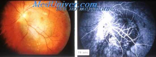 нарушения микроциркуляции