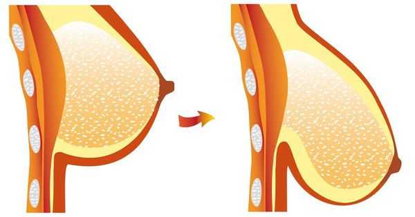 Опущение груди