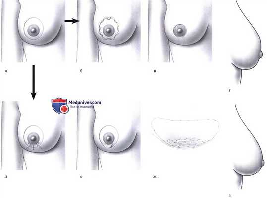 Мастопексия с использованием техники круглого блока