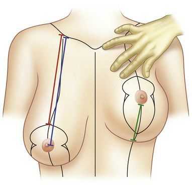 Сниженный уровень ареолы