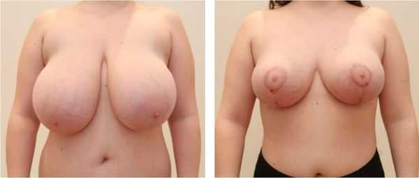 Редукционная маммопластика