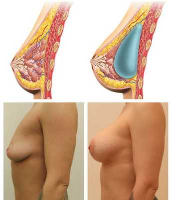 Устранение птоза I степени и псевдоптоза
