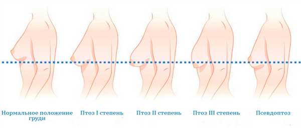 стадии заболевания