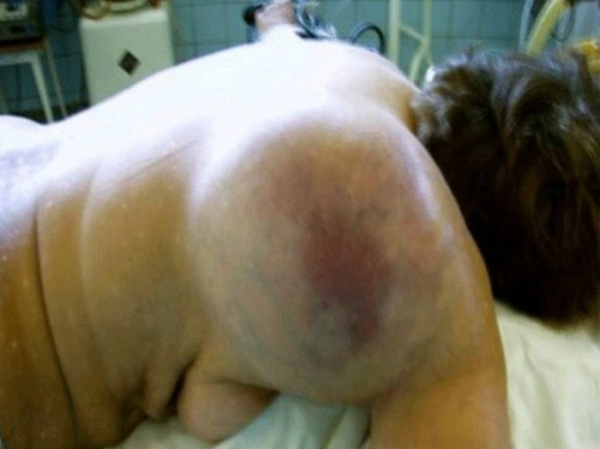 Саркома мягких тканей у детей