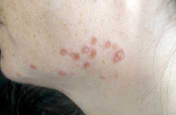 Виды саркомы мягких тканей