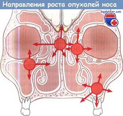 Направления роста опухолей носа