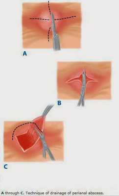 Дренирование межсфинктерного абсцесса