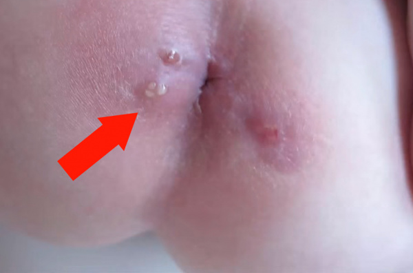 Подкожный парапроктит