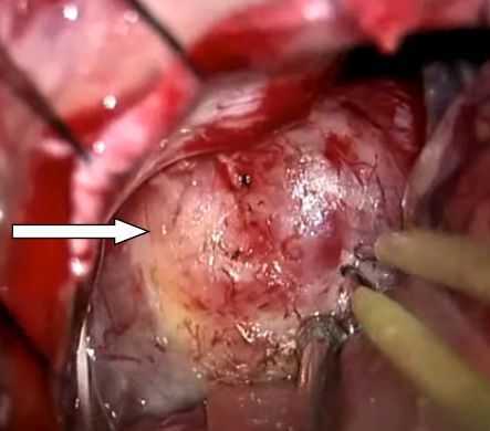 Интраоперационная фотография. Макроскопический вид невриномы слухового нерва (белая стрелка)