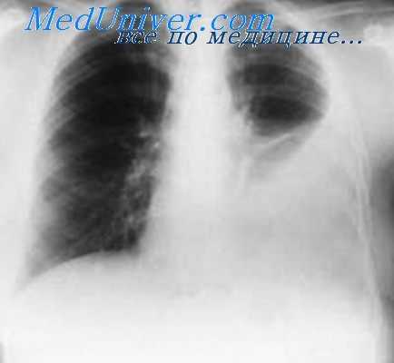 плевральные сращения