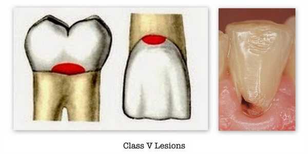 5 класс по Блэку - фото пример