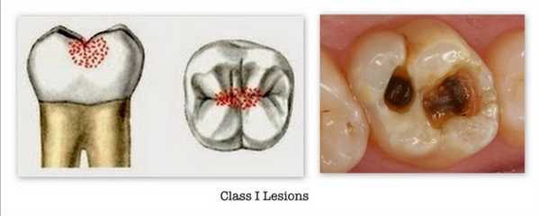 1 класс по Блэку - фото пример