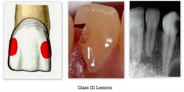 3 класс по Блэку - фото пример