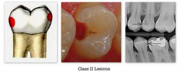 2 класс по Блэку - фото пример