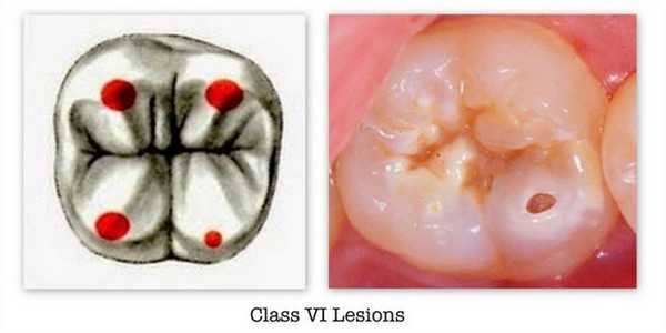 6 класс по Блэку - фото пример