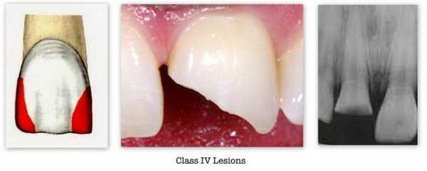 4 класс по Блэку - фото пример