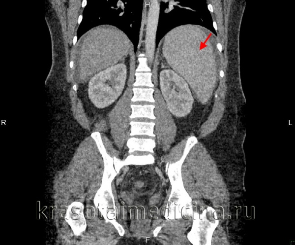 Гепатоспленомегалия