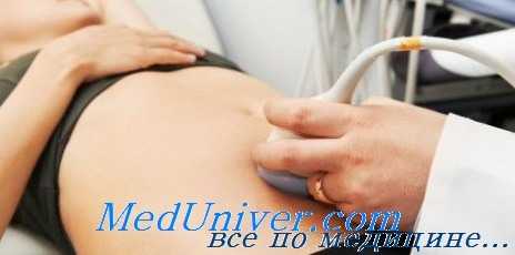 синдром гиперстимуляции яичников