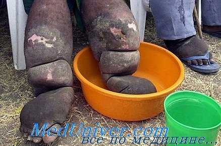 слоновость