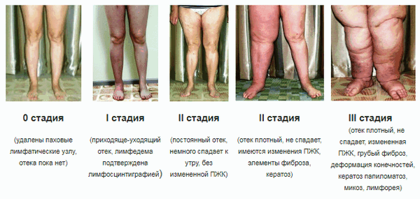 Элефантиаз