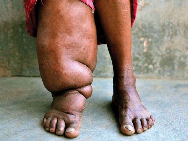 Слоновость