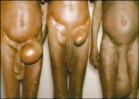 Элефантиаз