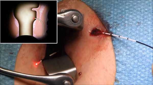 Лазерные технологии лечения параректальных свищей