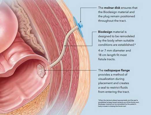 Лечение свища с использованием герметизирующих тампонов