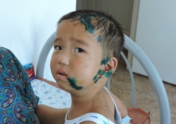 Укусы ядовитых змей