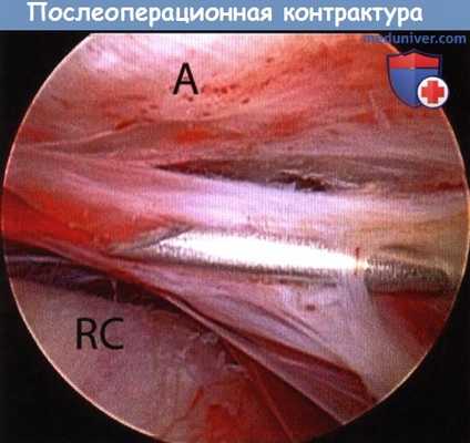 Послеоперационная контрактура