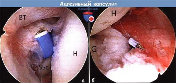 Техника операции при адгезивном капсулите