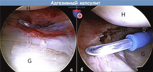 Техника операции при адгезивном капсулите