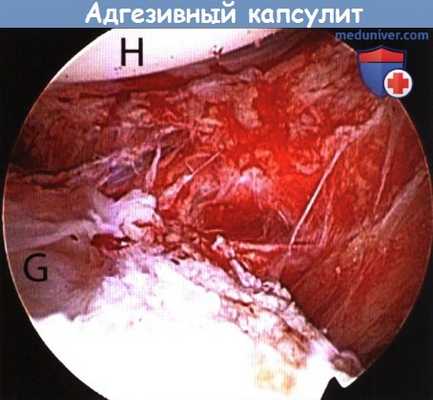Техника операции при адгезивном капсулите