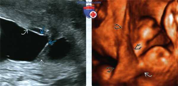 Лучевые признаки внутриматочных синехий у беременной