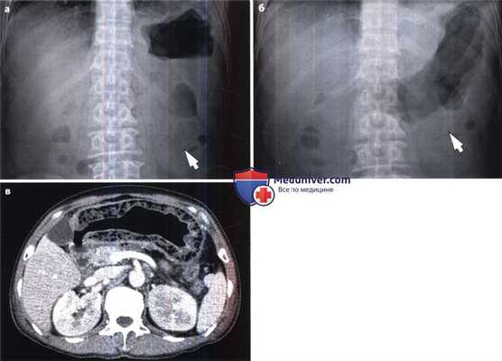 Рентгенограмма, КТ при гастрите