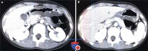 Рентгенограмма, КТ при гастрите