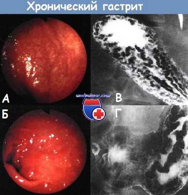 Хронический гастрит