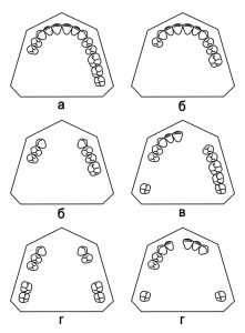 Классификация дефекта зубных рядов по Бетельману
