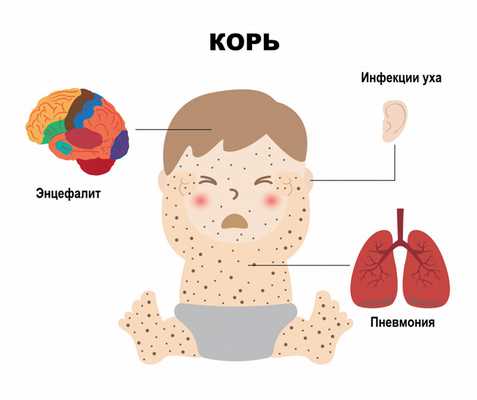 Коревой энцефалит.jpg