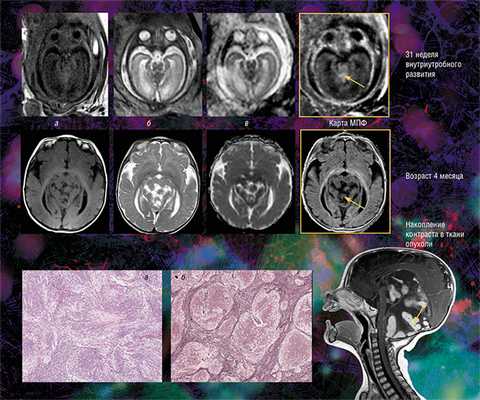 Медуллобластома - злокачественная опухоль центральной нервной системы, развивающаяся из эмбриональных клеток и локализующаяся преимущественно в мозжечке. Она составляет пятую часть всех опухолей головного мозга у детей. Формирование у ребенка врожденной медуллобластомы удалось проследить с внутриутробного периода. На традиционных МРТ-изображениях головного мозга (карте коэффициента диффузии воды - а и анатомических изображениях с различным контрастом - б, в) опухоль можно диагностировать после рождения: например, она хорошо видна в возрасте 4 месяцев. Однако в последнем семестре беременности опухоль не выделяется на фоне окружающей ткани, но ее можно увидеть на МПФ-карте, потому что медуллобластома содержит большое количество коллагена, влияющего на величину детектируемого сигнала МРТ. Справа - МРТ-изображение нервной системы больного в возрасте 4 месяцев, полученное при обычном сканировании с контрастным усилением. В возрасте 5,5 месяцев ребенку была сделана оперативная резекция опухоли. Внизу - гистологические срезы опухолевых фрагментов, окрашенных гематоксилин-эозином (а) и импрегнированных серебром (б), на которых видны множественные слившиеся опухолевые узлы, окруженные фиброзными волокнами, в состав которых входит коллаген. Фото из архива НМИЦ детской гематологии, онкологии и иммунологии им. Дмитрия Рогачева (Москва)