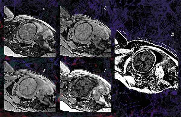 Карта МПФ (д) реконструируется с помощью специальной математической программы из четырех видов исходных изображений: в режиме переноса намагниченности (а) и протонной плотности (б), референсного (в) и анатомического (г), которые можно получить на обычном томографе