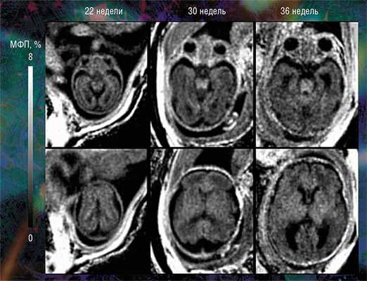 Наиболее высокие значения МФП и, соответственно, степени миелинизации выявлены в стволовых структурах головного мозга плода. Меньшие значения МПФ обнаружены в таламусе и мозжечке, а минимальные - в полушариях головного мозга. При этом количество миелина в центральных мозговых структурах стабильно увеличивается с эмбриональным возрастом