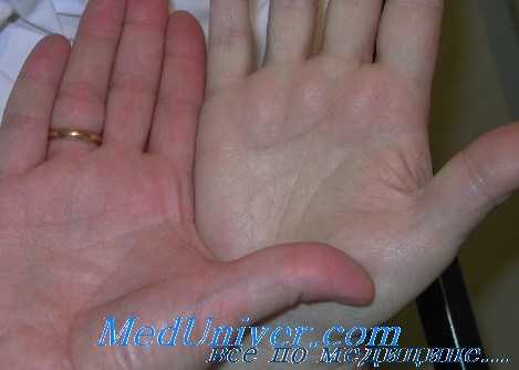 клиника анемии