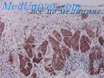 первично множественные опухоли