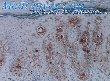 первично-множественные опухоли