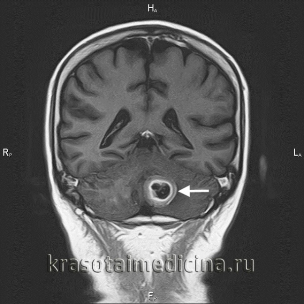 Первично-множественные опухоли