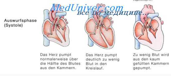 кардиальная астма