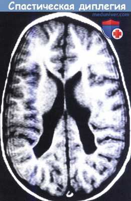 Спастическая диплегия