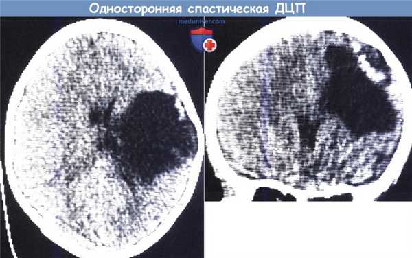 Односторонняя спастическая ДЦП